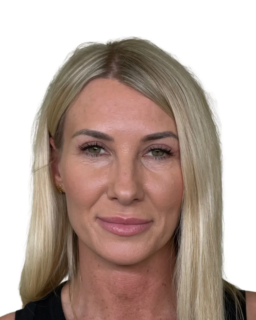 Po zabiegu — blefaroplastyka powiek, ujęcie na wprost