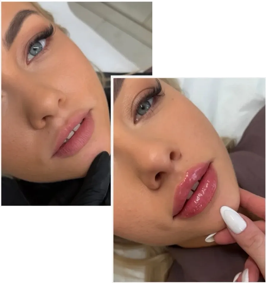 Przed i po — modelowanie ust 1 ml kwasu hialuronowego