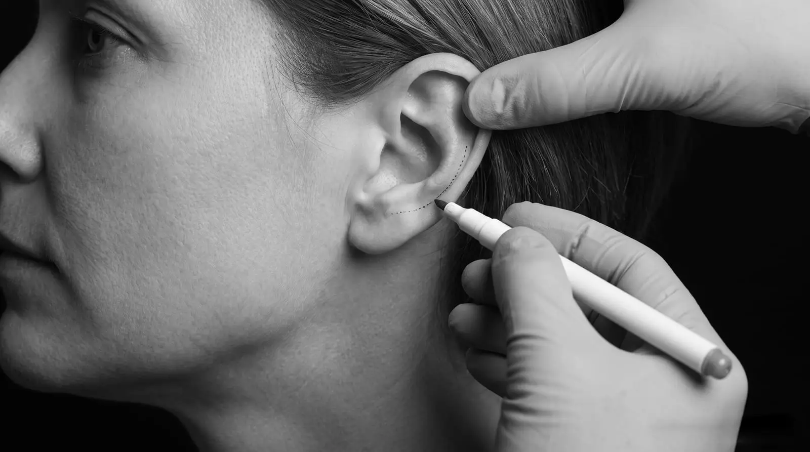 Planowanie otoplastyki — dłoń w rękawiczce odchyla małżowinę, druga zaznacza markerem linię fałdu ucha